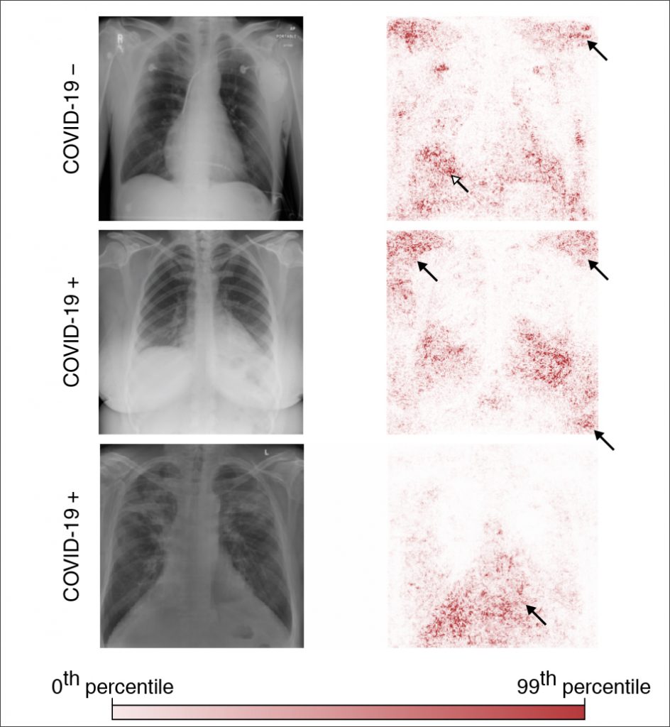 Figure from paper showing three x-ray images paired with color-coded saliency maps indicating weight of factors in model prediction