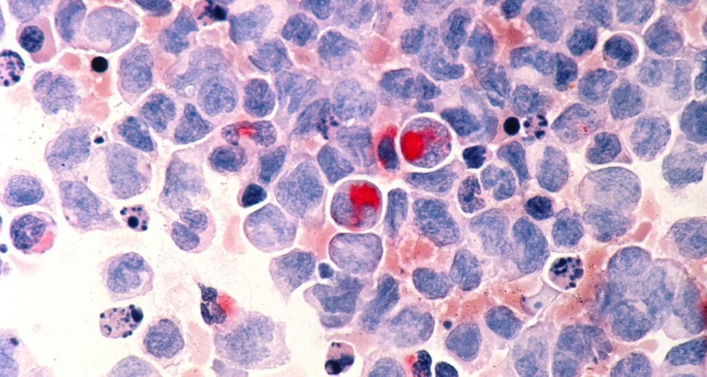 Microscopic image of human cells colored in varying shades of blue and red, with bright red stain signifying cancerous cells.