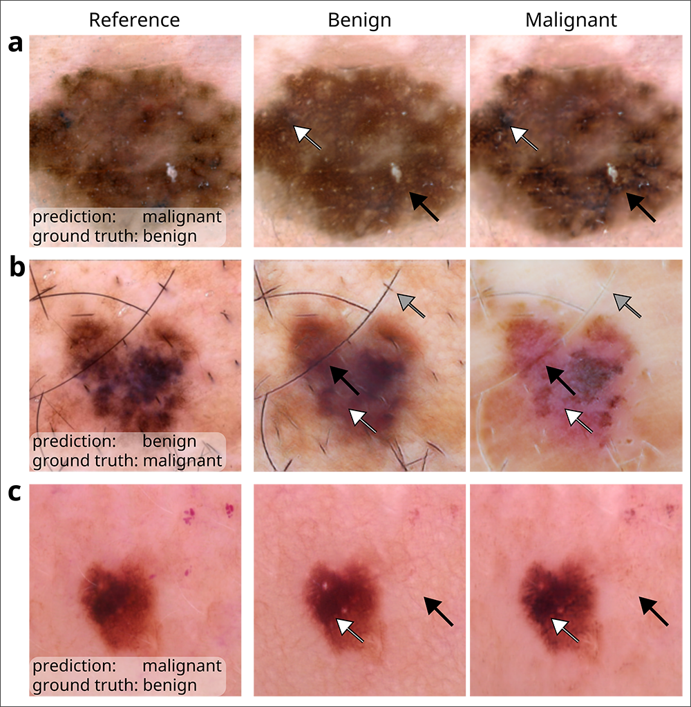 Nine images of melanoma or melanoma-like skin lesions of varying shapes and shades of brown and pink, arranged in three rows of three. The left column are reference images; the middle column are variations of the reference images altered to prompt a benign prediction; and the right column are images altered to prompt a malignant prediction. Arrows in the two columns of adjusted images point to factors in the image, such as lesion pigmentation or the presence of hair, that contributed to the predictions. Row a shows a malignant prediction when the ground truth is benign; row b shows a benign prediction when the ground truth is malignant; and row c shows a malignant prediction when the ground truth is benign.